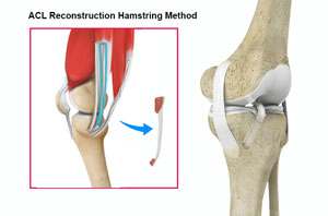 ACL Reconstruction