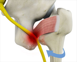 Ischiofemoral Impingement