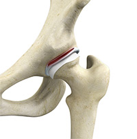 Hip Labral Tear