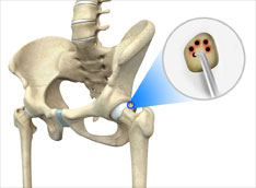 Hip Microfracture