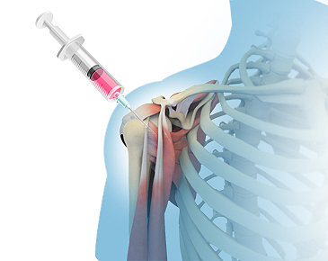 Stem Cell Therapy Stem Cell Therapy