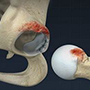 Femeroacetabular Impingement Surgery