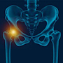 Hip Pain