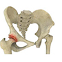 Osteoarthritis of Hip