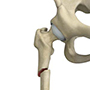 Subtrochanteric Fracture