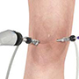 Knee Arthroscopy