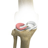 Lateral Meniscus Syndrome