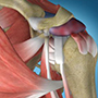 Shoulder Impingement